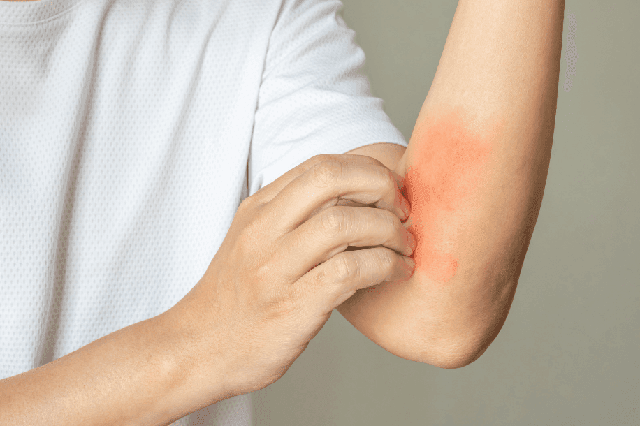 homem coçando ferida vermelha no braço